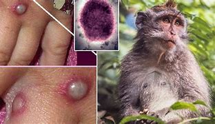 1Monkeypox Virus.jpg